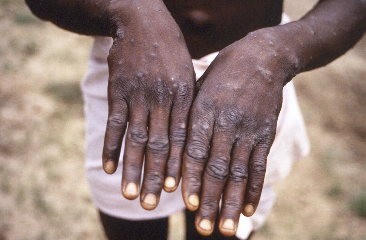 Monkeypox hands image 1997 CDC