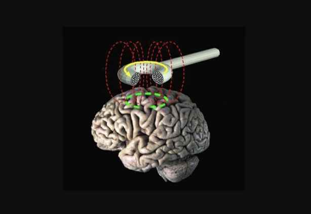 Transcranial magnetic stimulation