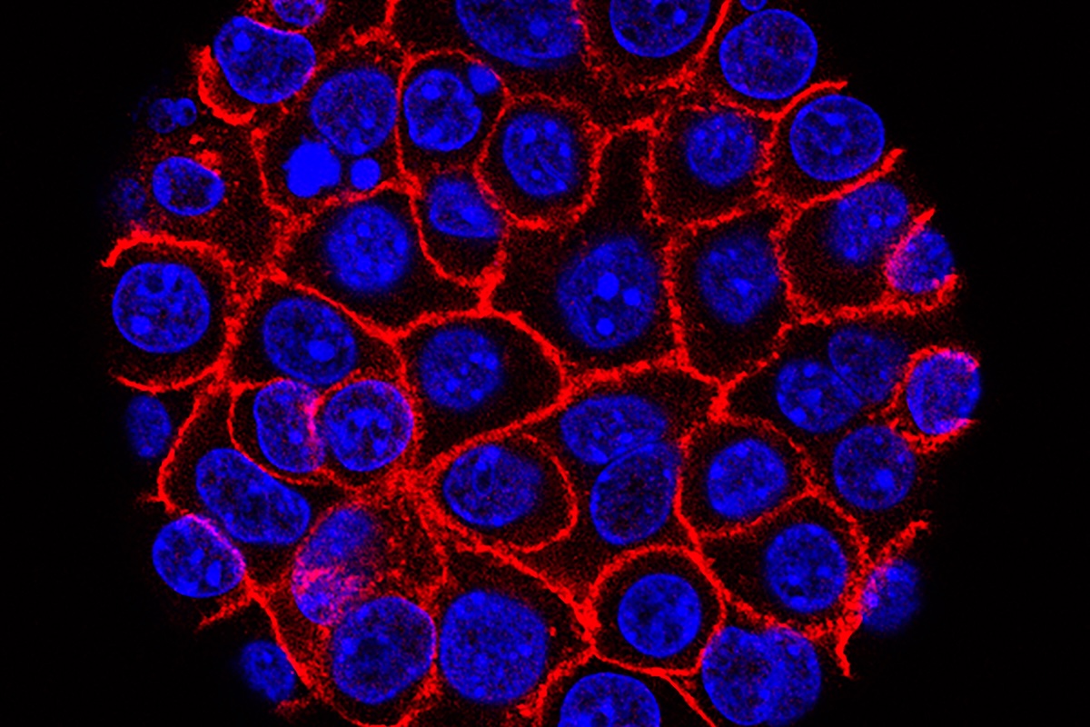 Pancreatic Cancer cells for daraxonrasib story 06-03-2026